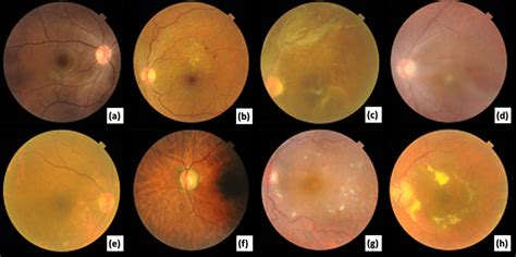 Different Retinal Color Fundus Images With Different Ods A Normal