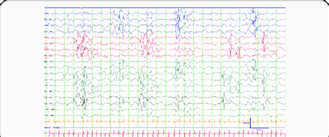 Eeg During Active Sleep 7uvmm 15mmsec Demonstrating Asynchronous