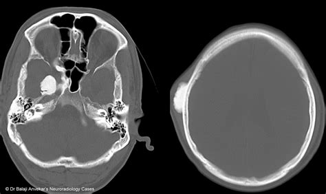 Dr Balaji Anvekar FRCR: Paranasal sinus osteoma CT