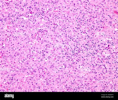 Hairy Cell Leukaemia Light Micrograph Histiocytic Sarcoma Is A Malignant Tumour With