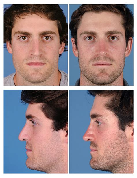 Rhinoplasty Before And After Photos