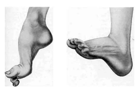 Конская стопа у ребенка - что это за болезнь, фото симптомов, лечение и ...
