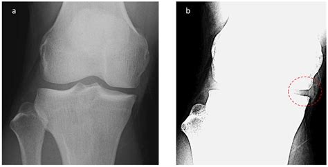 Jcm Free Full Text Evaluation Of Medial Meniscal Extrusion Using