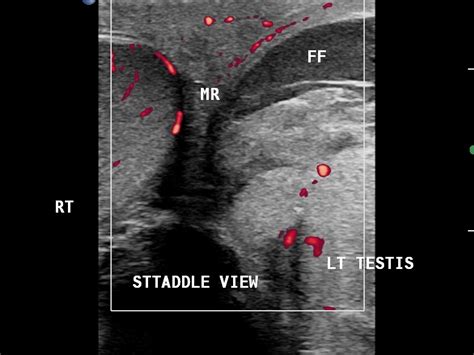 Hematocele Ultrasound