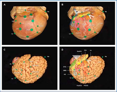 Figure 1 From Cranial And Cerebral Anatomic Key Points For Neurosurgery