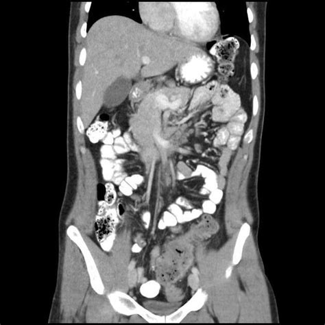 Sigmoid Colon Cancer
