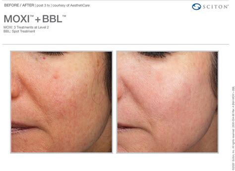 BBL MOXI Skin Revitalization In Largo FL Dr K S Med Spa