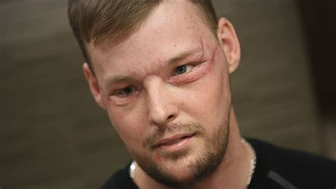 Twin tragedies give survivor a new face at Mayo Clinic | MPR News