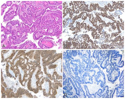 Primary Adenocarcinoma Of The Urinary Bladder Pt2 Hande Displaying