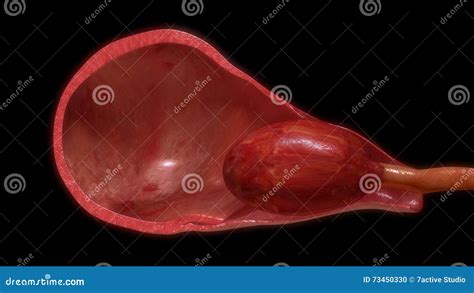 O Que Fazer Quando O Útero Sai Para Fora - Puxando a Placenta Fora Do útero Foto de Stock - Imagem de materno ...