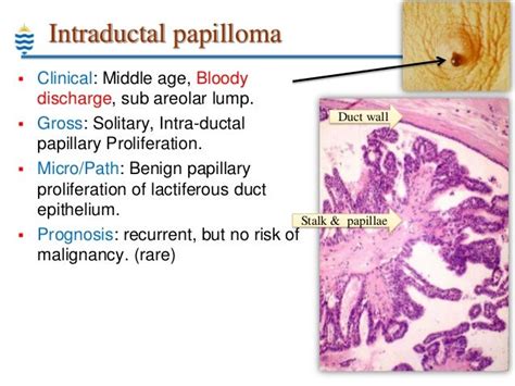 benign squamous papilloma - pictures, photos