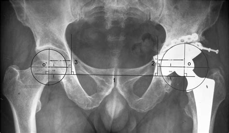 midterm results  uncemented acetabular reconstruction