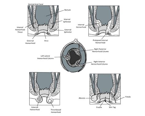 thrombosed hemorrhoid  perianal hematoma  henry briggs blog