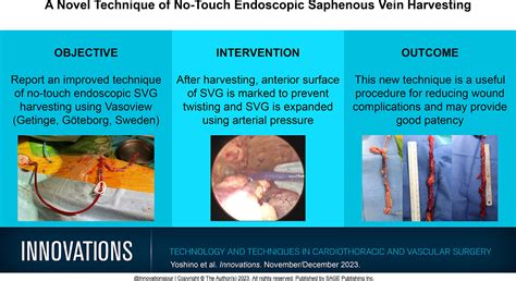 A Novel Technique Of No Touch Endoscopic Saphenous Vein Harvesting