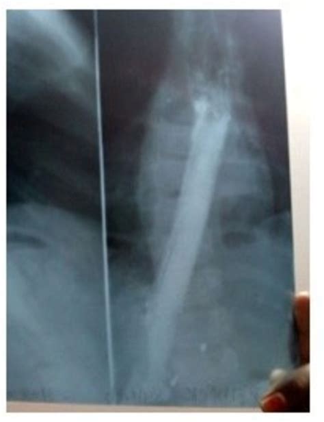 Postoperative image showing the stent. | Download Scientific Diagram