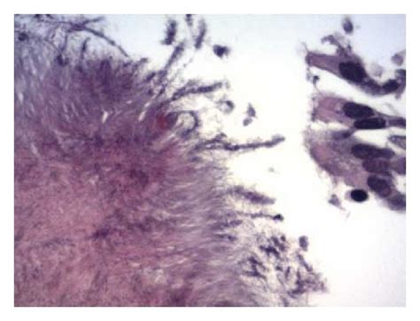 Bronchoscopic biopsy specimen demonstrating colonies of organisms with ...