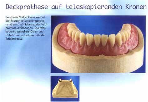 Deckprothesen Coverdenture Auf Teleskopkronen Boger Zahntechnik