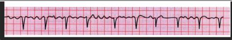 Atrial Fibrillation Flashcards Quizlet