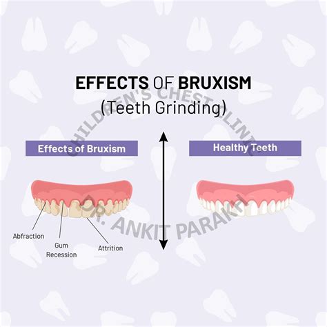 Teeth Grinding or Bruxism in Children - Dr. Ankit Parakh – India's best