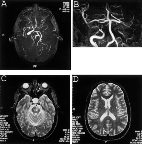 Magnetic Resonance Angiography Mra And Magnetic Resonance Imaging