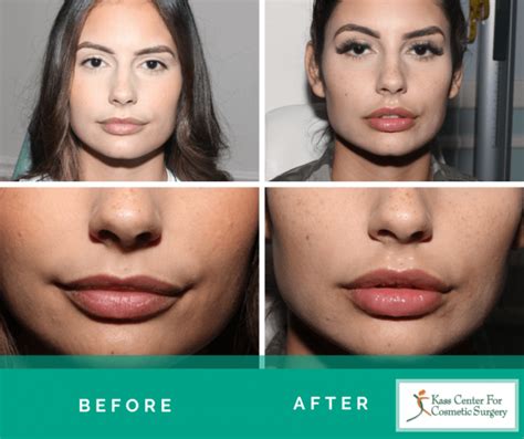 Lip Plastic Surgery - Before & Afters - Kass Center for Cosmetic Surgery