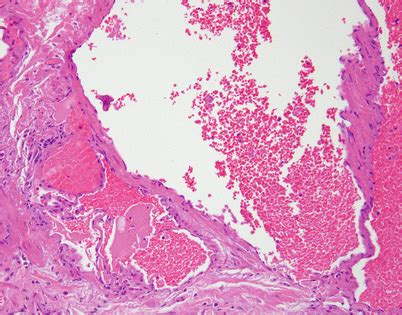 Soft Tissue Tumors of the Mediastinum | Basicmedical Key