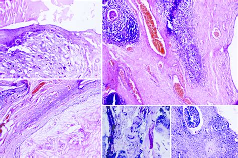 Histopathological Examination Revealed Multiple Cystic Spaces Lined By