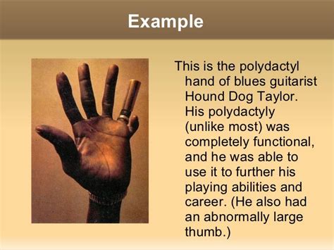 Polydactyly