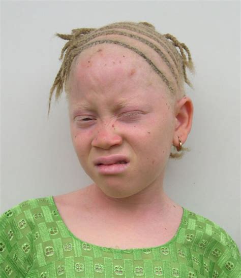 Albinism - Types, Symptoms, Causes, Diagnosis and Treatment