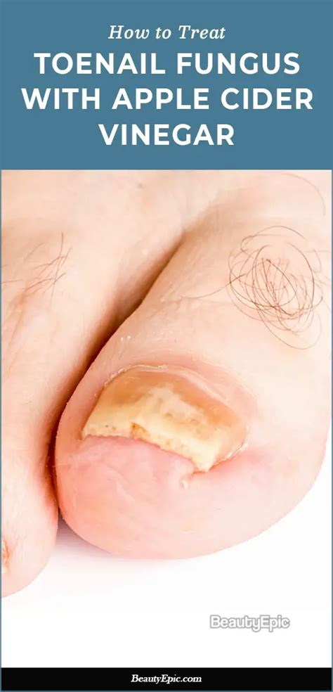 How To Prepare An Apple Cider Vinegar For Toenail Fungus In 2025