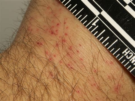 What Causes Bed Bugs Science Trends