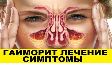 Диета При Синусите У Взрослых — Похудение Диета Правильное Питание