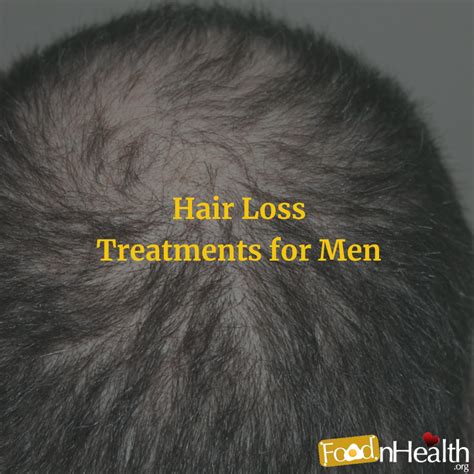 Top 4 Hair Loss Treatments for Men - Food N Health