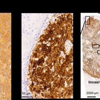 Expression of BRAF V600E mutation in melanoma tissue. With routine... | Download Scientific Diagram