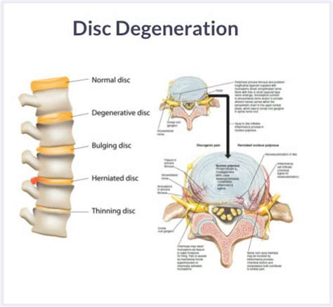 Cell Treatments for Back Pain and Degenerative Disc Disease