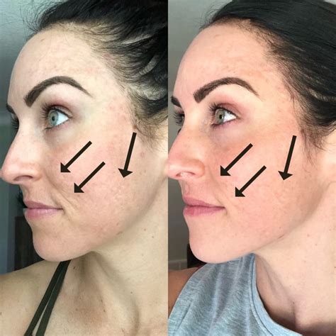 My Experience W Microneedling And Why Im Obsessed Paleomg