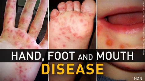 Hand Foot And Mouth Disease In Mouth