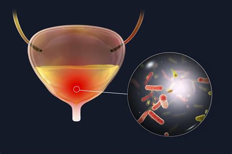 Non Antibiotic Treatment Shows Promise For Preventing Recurrent Urinary