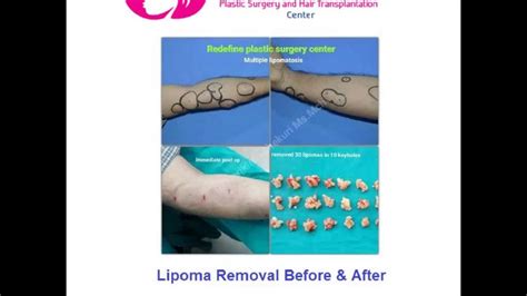 Lipoma Removal Results Lipoma Treatment Before And After Photos