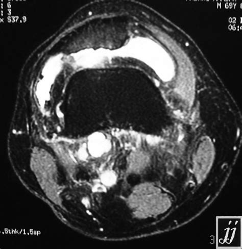 Popliteal and supra popliteal cyst – Radiopaedia