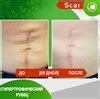 Купить Карипаин Scar гель ферментный для кожи с Коллагеназой и Тизолем ...