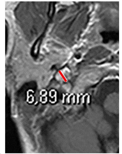 Magnification Of A Contrast Enhanced T1 Weighted Axial Magnetic