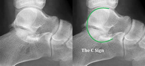 Tarsal Coalition - Ankle, Foot and Orthotic Centre