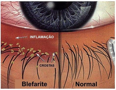 Desconforto Suas Lentes De Contato Pode Ser Blefarite