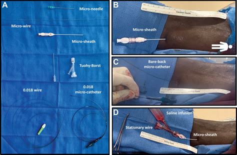 Modified Bare Back Micro Retrograde Tibial Arterial Access To