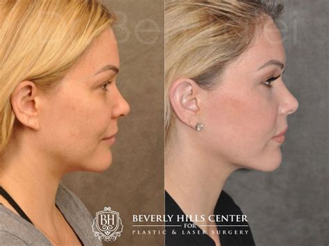 Profound Rfskin Tightening Before And Afters Beverly Hills Center