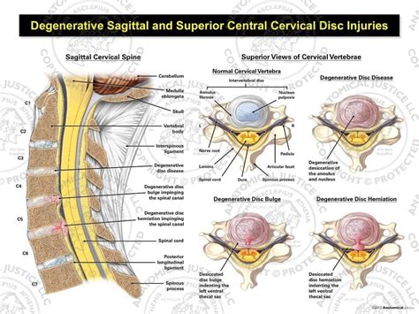 Cervical Degenerative Disc Disease With Central Disc Injuries