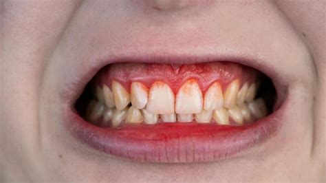 Gingivitis Causes Symptoms And Treatment