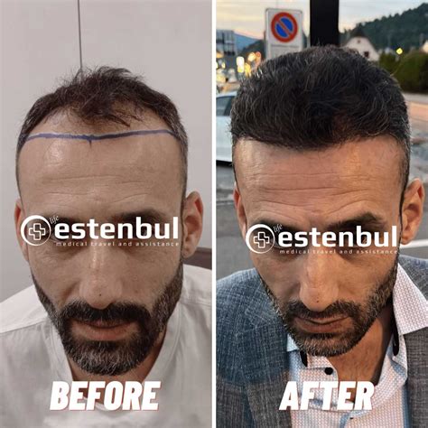 hair transplant