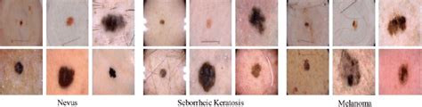 Some Dermoscopy Image Samples Of Nevus Seborrheic Keratosis And